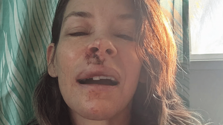 Evangeline Lilly comparte una preocupante actualización de su salud tras su accidente